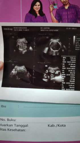 Ada kah yg sama dengan hasil usg bunda"dengan saya.yg kehamilan nya 28 w.kira"banyak yg cwe apa cwo