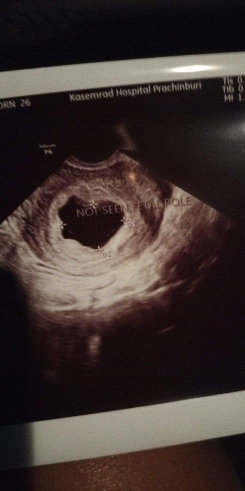 รบกวนสอบถามค่ะ ท้อง6wมีเลือดออก ซาว์ดแล้วถุงตั้งครรภ์ไม่สวยและไม่พบตัวเด็ก