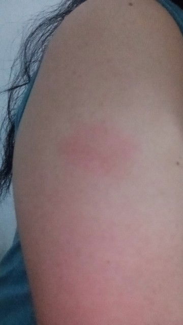 Bun,emg kalo udh disuntik TT udahnya jd bengkak sm merah ya? Baru pertama kali soalnya huhu