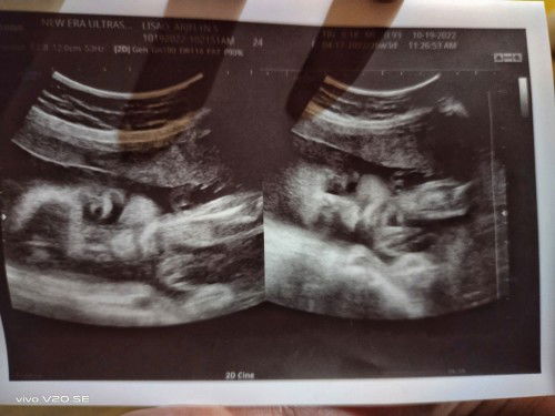 Breech Baby ? - 23 weeks