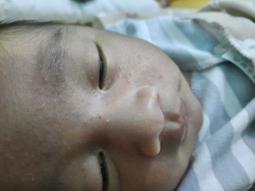 Bruntusan di wajah bayi new born