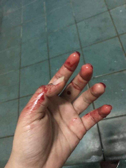 ภาวะแท้งคุกคาม / เลือดออก