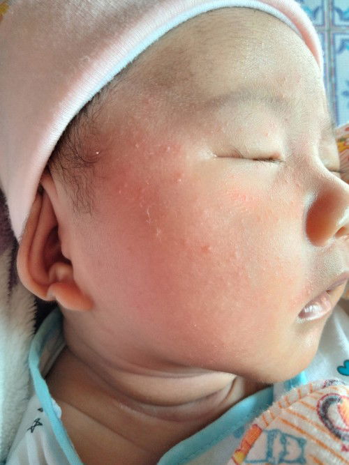 ทารกผื่นขึ้นที่หน้า