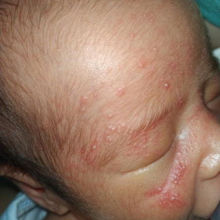 Baby acne / Rashes (?)