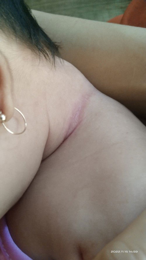 Cổ bé nhà e bị đỏ các mom có biết thuốc gì trị hết k ạ