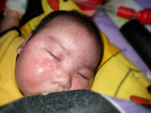 เเม่ๆขอคำปรึกษาหน่อยค่ะสงสารลูกมาก น้องจะเเพ้อาหารหรือเปล่า