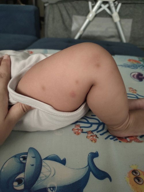 Parut pepijat/gigit nyamuk