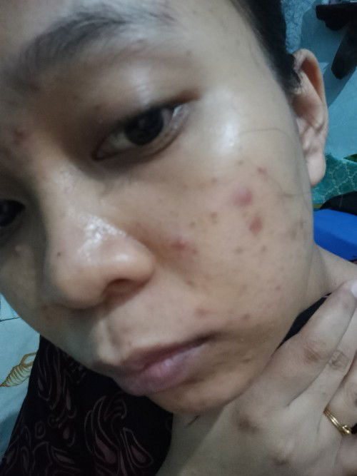 Jerwatan parah hamil 3 bulan