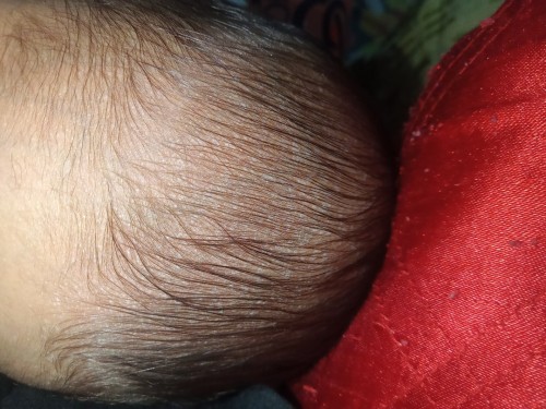 Allergy? or Hndi hiyang sa Baby shampoo