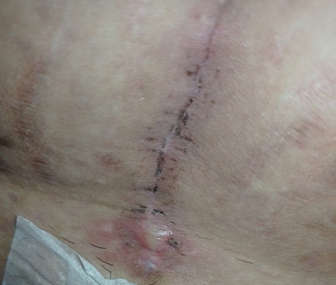 Cesarean wound