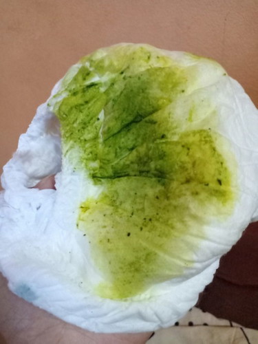 อุจจาระสีเขียวผิดปกติมั้ย