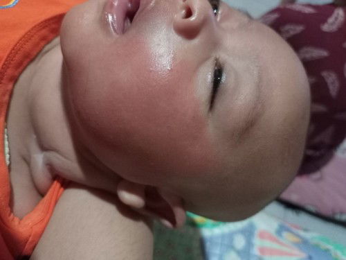 Ruam Merah Hilang Timbul