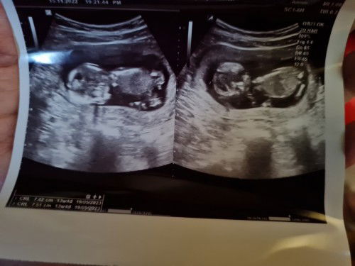 Baca usg caranya gimana ya bund??