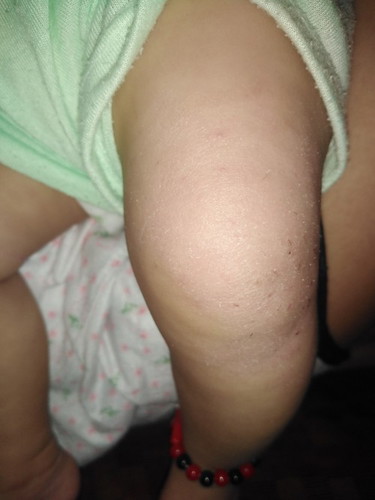Dry skin ni lo