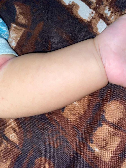 Tampek pada anak usia 3bulan