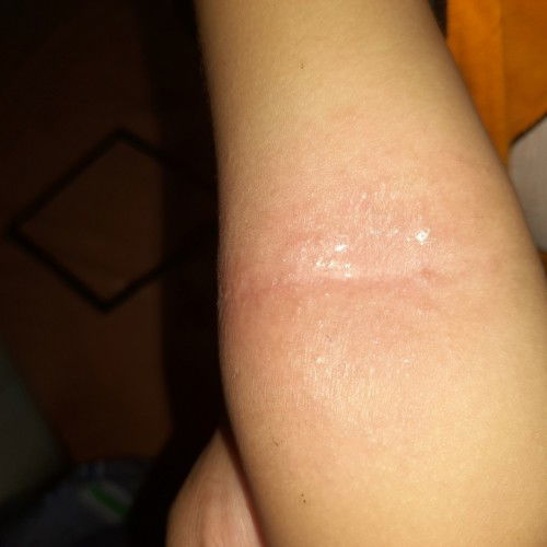 Bunda, saya mau nanya biasanya kalau anak 16 bulan merah² dilipatan siku obatnya apa ya?