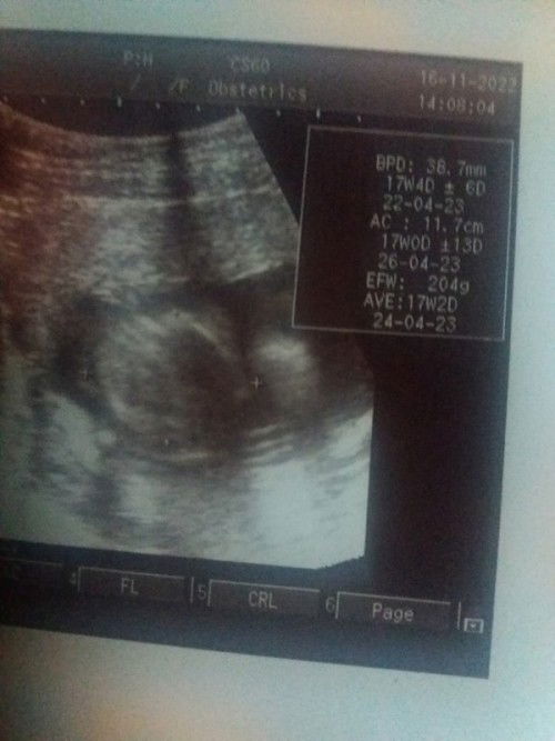 Hasil usg 17wek