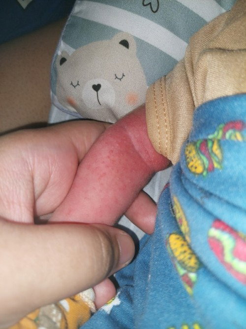 Beruntusan dan Biang Keringat