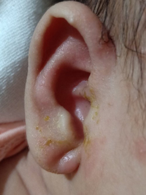 Mga momsh ear infection po ba yan? nag aalala na po ako.