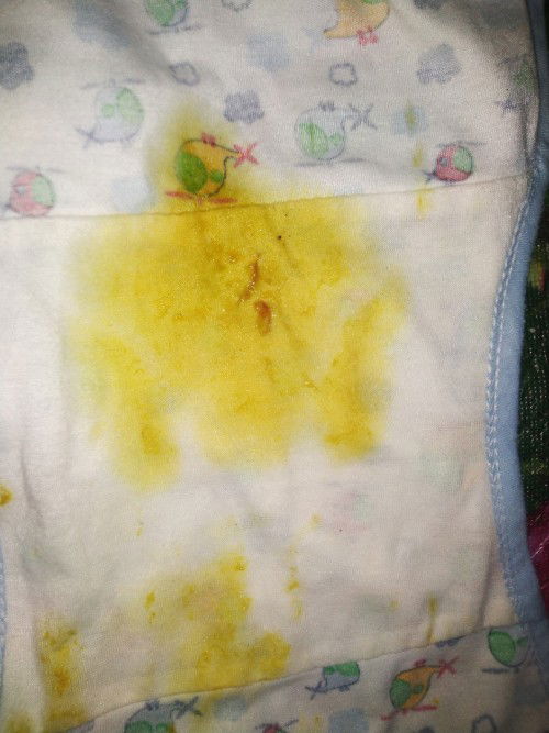 Sbagai ibu baru saya mau tanya..
Knp bab anak saya ada sedikit bercak darah nya?Mencret dan berbusa?
