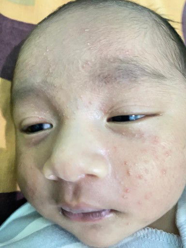 Jerawat bayi new born