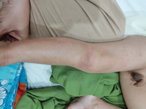 ภูมิแพ้ผิวหนัง