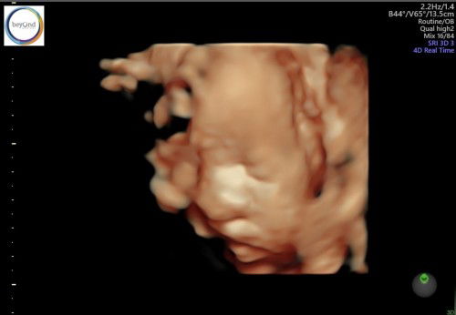 Bayi sungsang dan terlilit tali pusat saat 32w