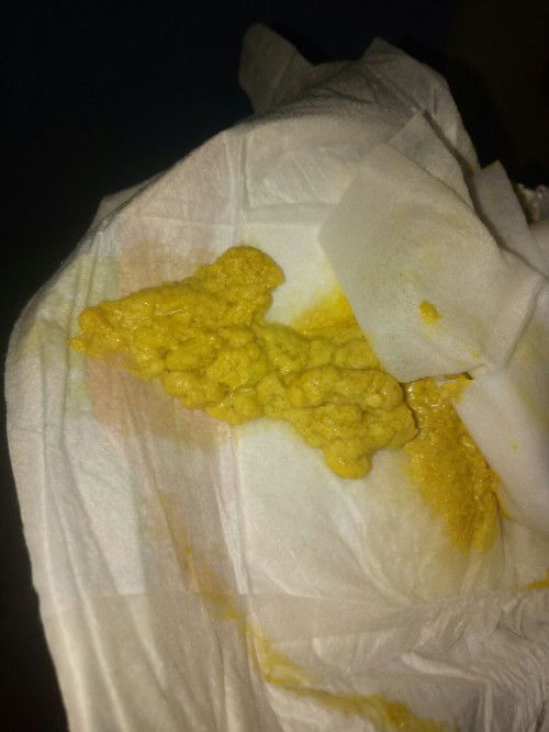 Bun ada yg sma ga tekstur pupnyaa anak ku full sufor