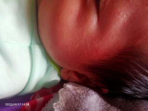 ผื่นอะไรคะ สอบถามผู้รู้ทุกท่านค่ะ