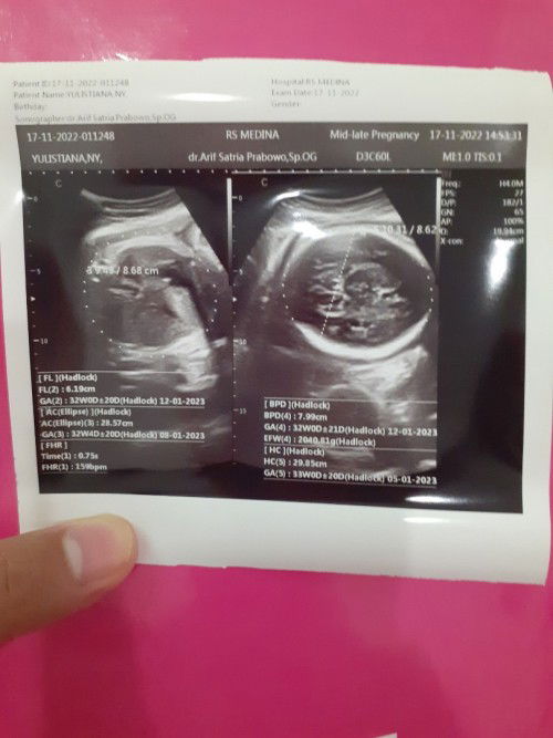 34 weeks, Ketuban tinggal sedikit