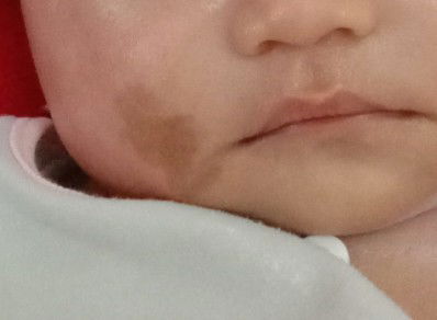 Tanda lahir pada bayi usia 2 bulan