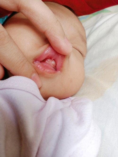 Normal or lip-tied?