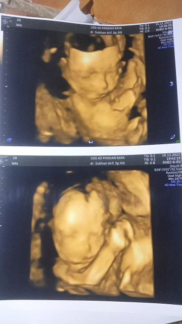 Bingung dengan hasil usg