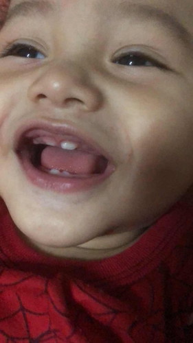 ฟันด้านล่างน้องขึ้นแบบนี้จะเบี้ยวมั้ยคะ