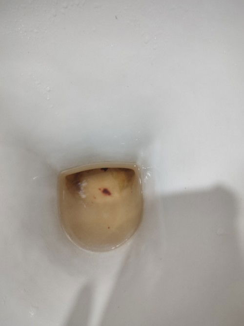 ตั้งครรภ์ได้ 9สัปดาห์คะ ตื่นมาเข้าห้องน้ำแล้วมีเลือดออกมา กังวลมากเลยคะ ขออภัยในรูปด้วยนะคะคะ