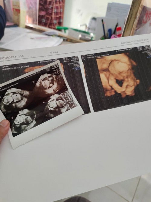 Tanya tentang USG hasil kembar atau tunggal