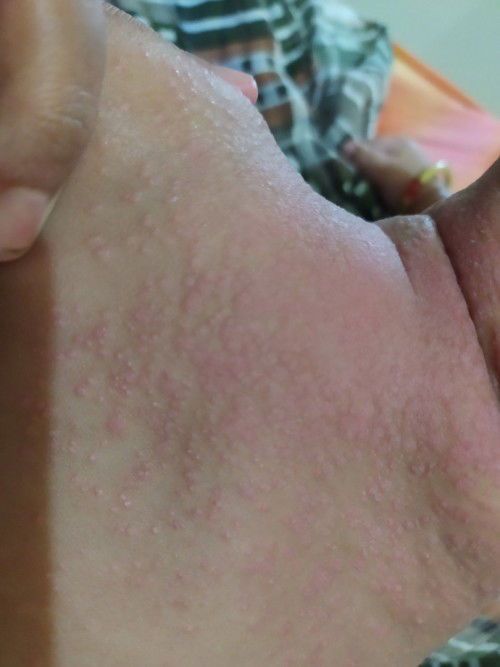 Bintik di badan bayi