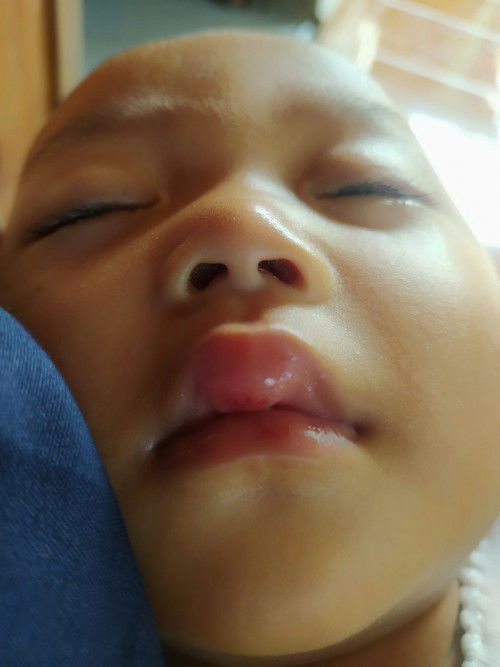 Obat bibir bayi kebentur kramik dong bun