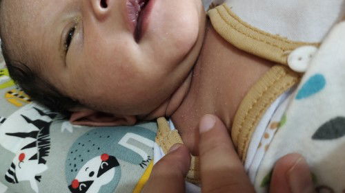 Biang keringat atau bruntusan ?