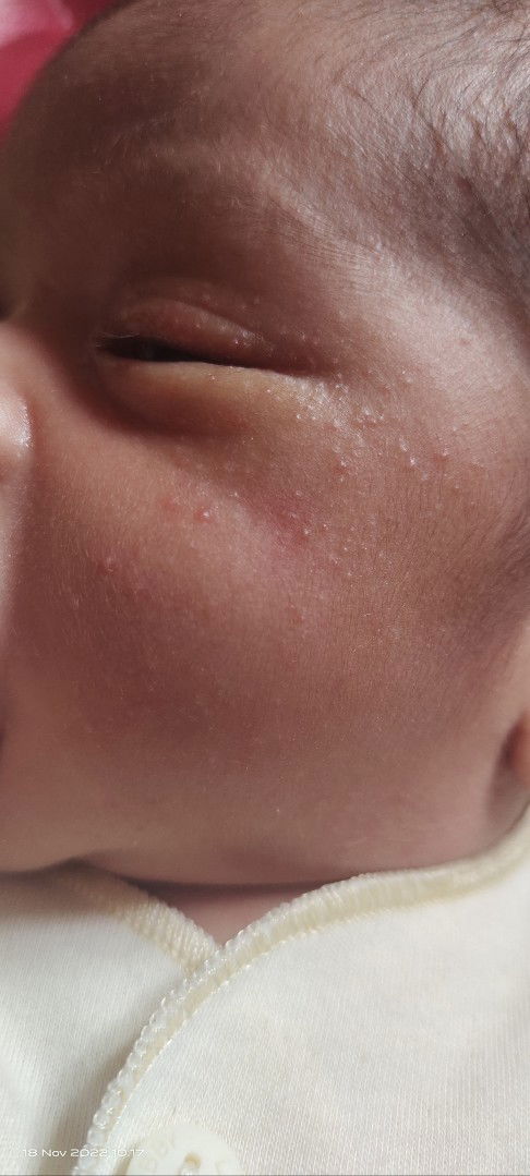 Bintik pada pipi dan muka bayi