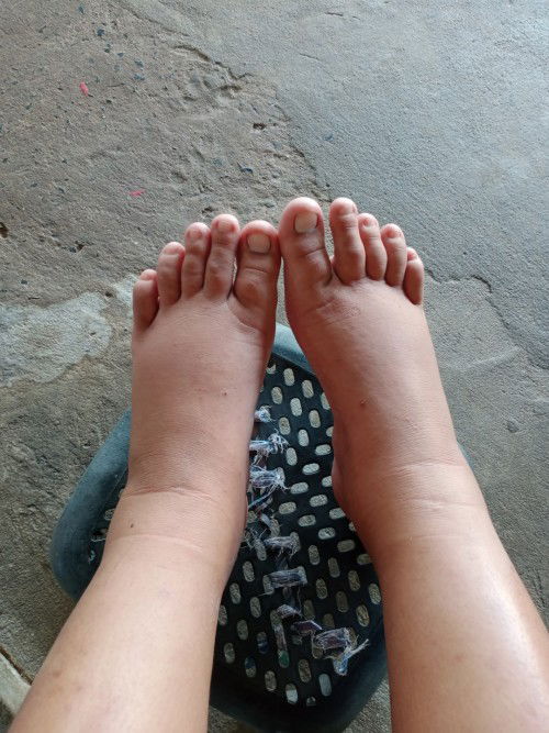 ขาบวมเกิดจากอะไร