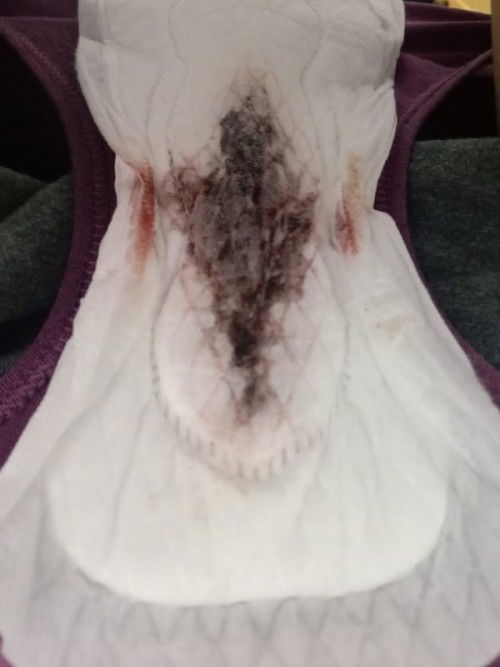 ตอนแรกเราตรวจเจอ 2 ขีดแล้วพอ 5-6 วันเหมือนมีประจำเดือนมาหมายความว่าอะไรคะน้องหลุดไปแล้วหรอ