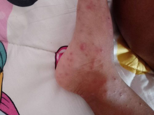 มือเท้าปาก