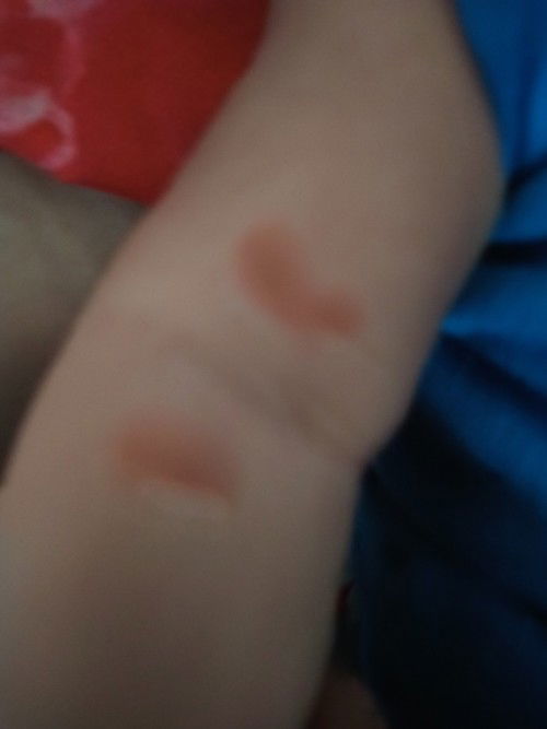 Bangun tidur tiba tiba kulit bayi merah