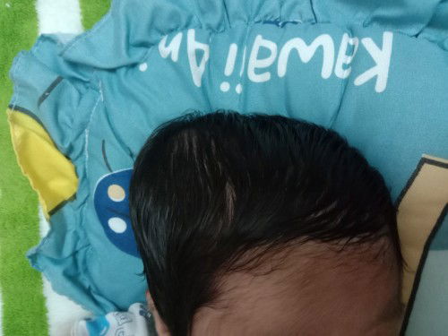 ตอนคลอดหมอบอกหัวเบียดกับอุ้งเชิงกราน