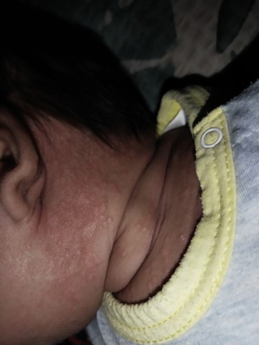 Skin rashes