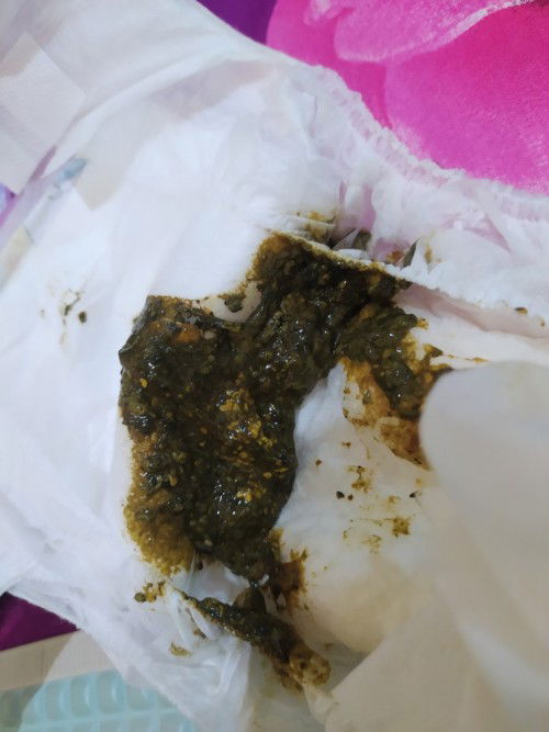 Pemberian susu hipoalergenik