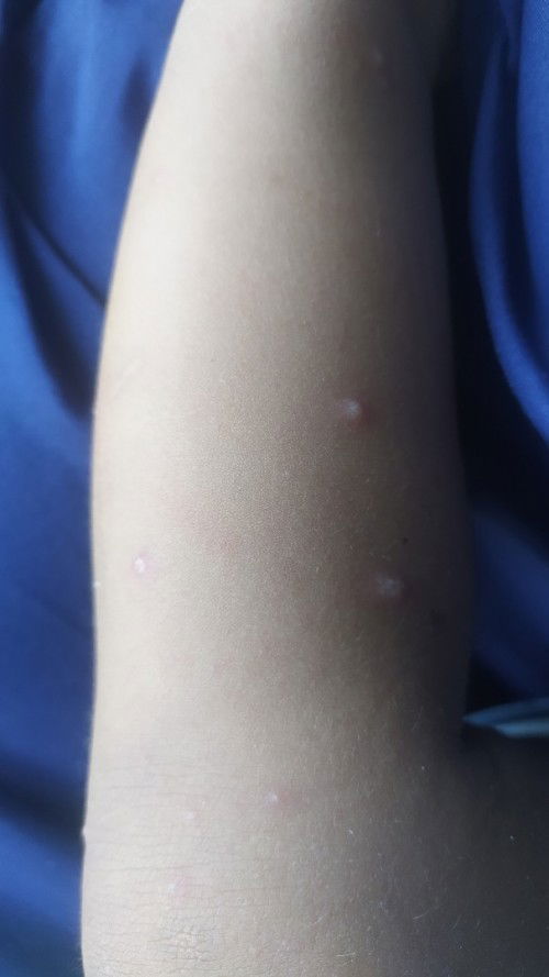 Flu singapur di usia 17 bulan