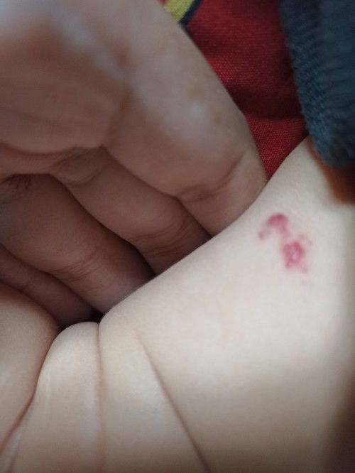 Apakah ini termasuk ruam popok?