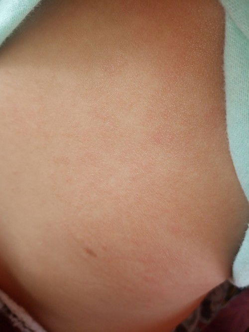 แบบนี้​เรียกผื่นร้อนไหมค่ะ